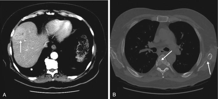 FIGURE 16-7, Contrast-enhanced computed tomography (CT) demonstrates peripheral hepatocellular carcinoma (HCC) in a patient with cirrhosis ( A ; arrow ). The skeletal windows ( B ) reveal multifocal osseous metastases (arrows) .