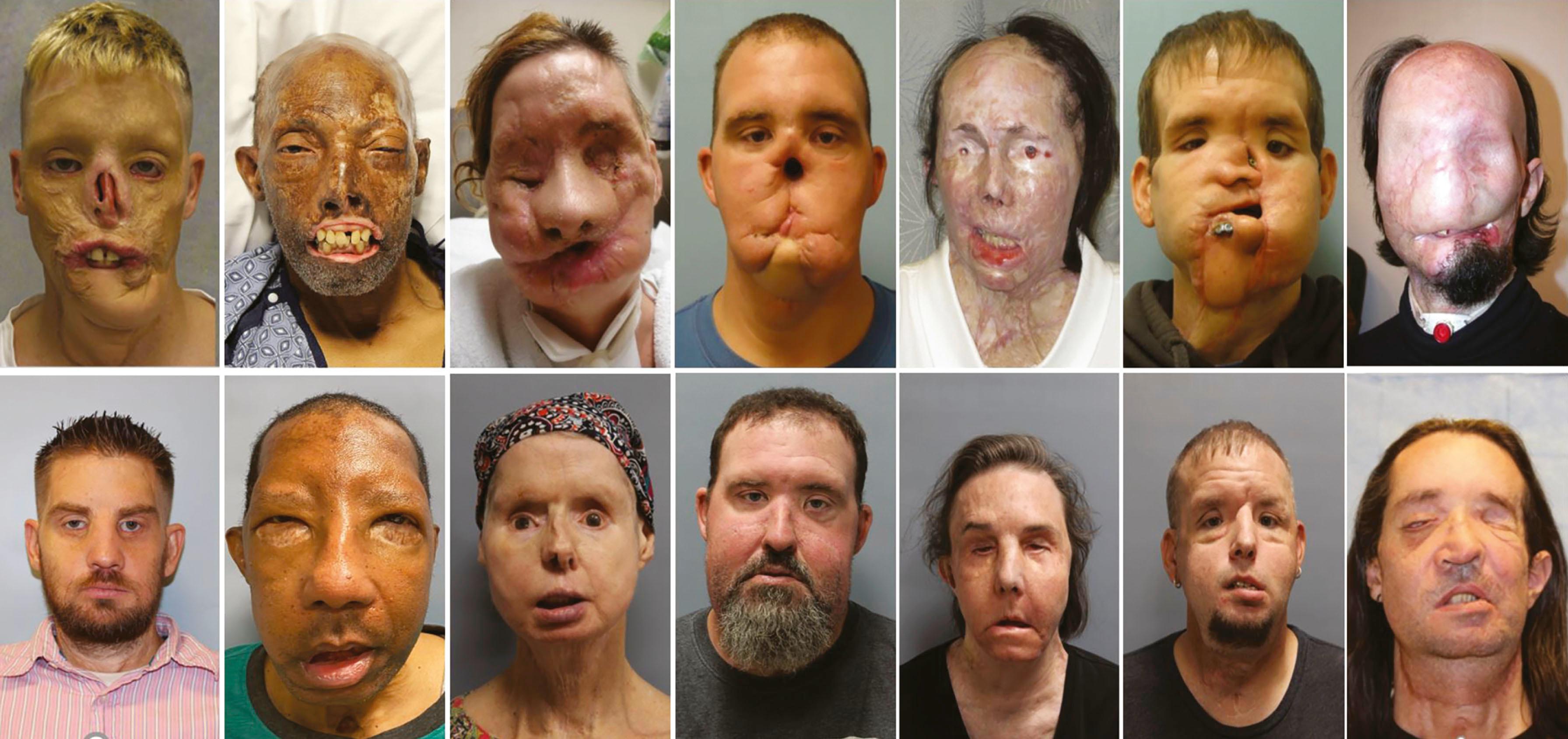 Figure 32.1, Face transplant patients before (top row) and after (bottom row) transplantation.