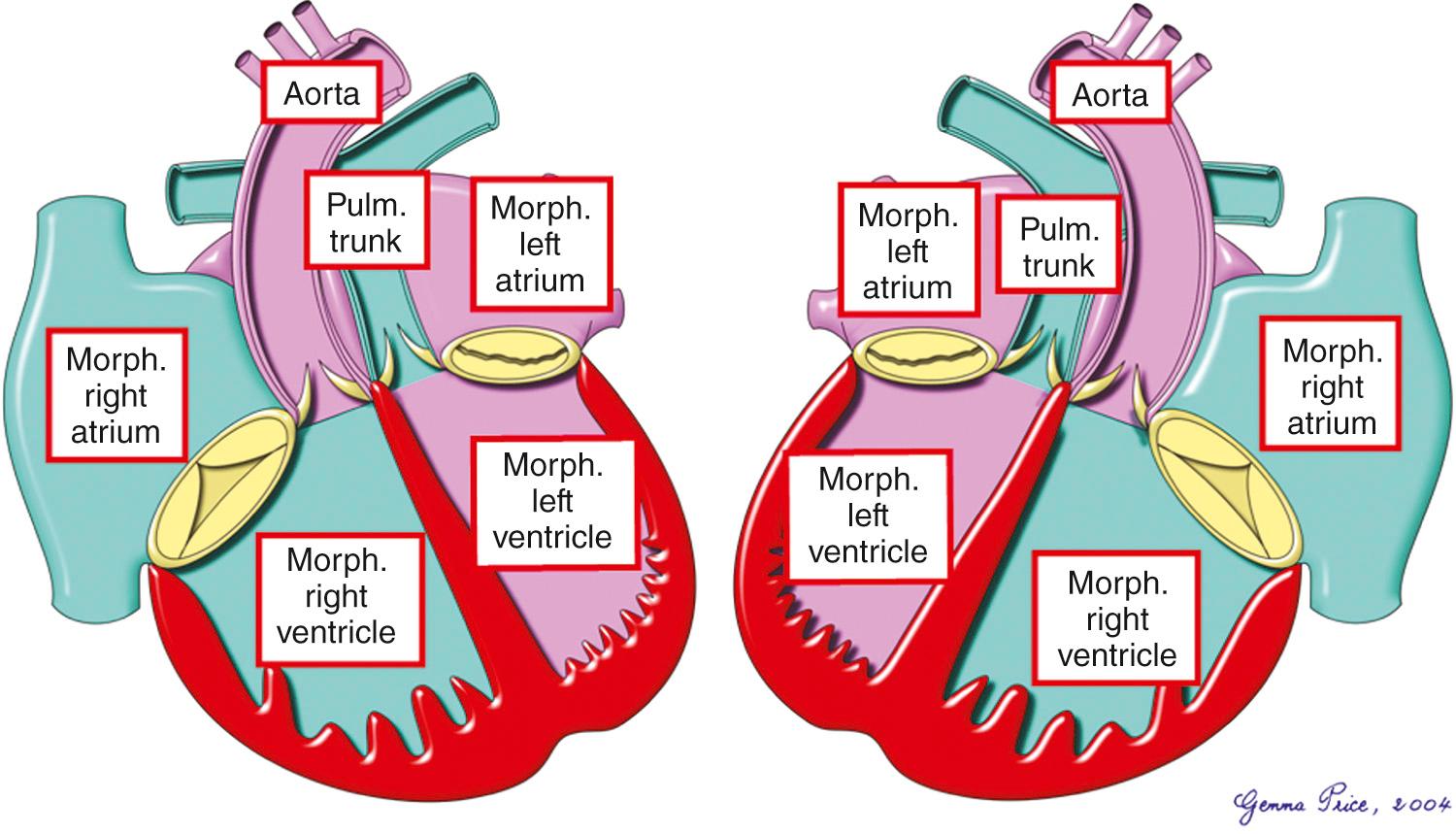 Fig. 37.1, Segmental combinations producing the lesion described as transposition, namely concordant atrioventricular and discordant ventriculoarterial connections. As shown, the lesion can exist in either the usual atrial arrangement (left) or in the mirror-imaged variant (right) . Note that the aorta is usually left sided with the mirror-imaged variant.