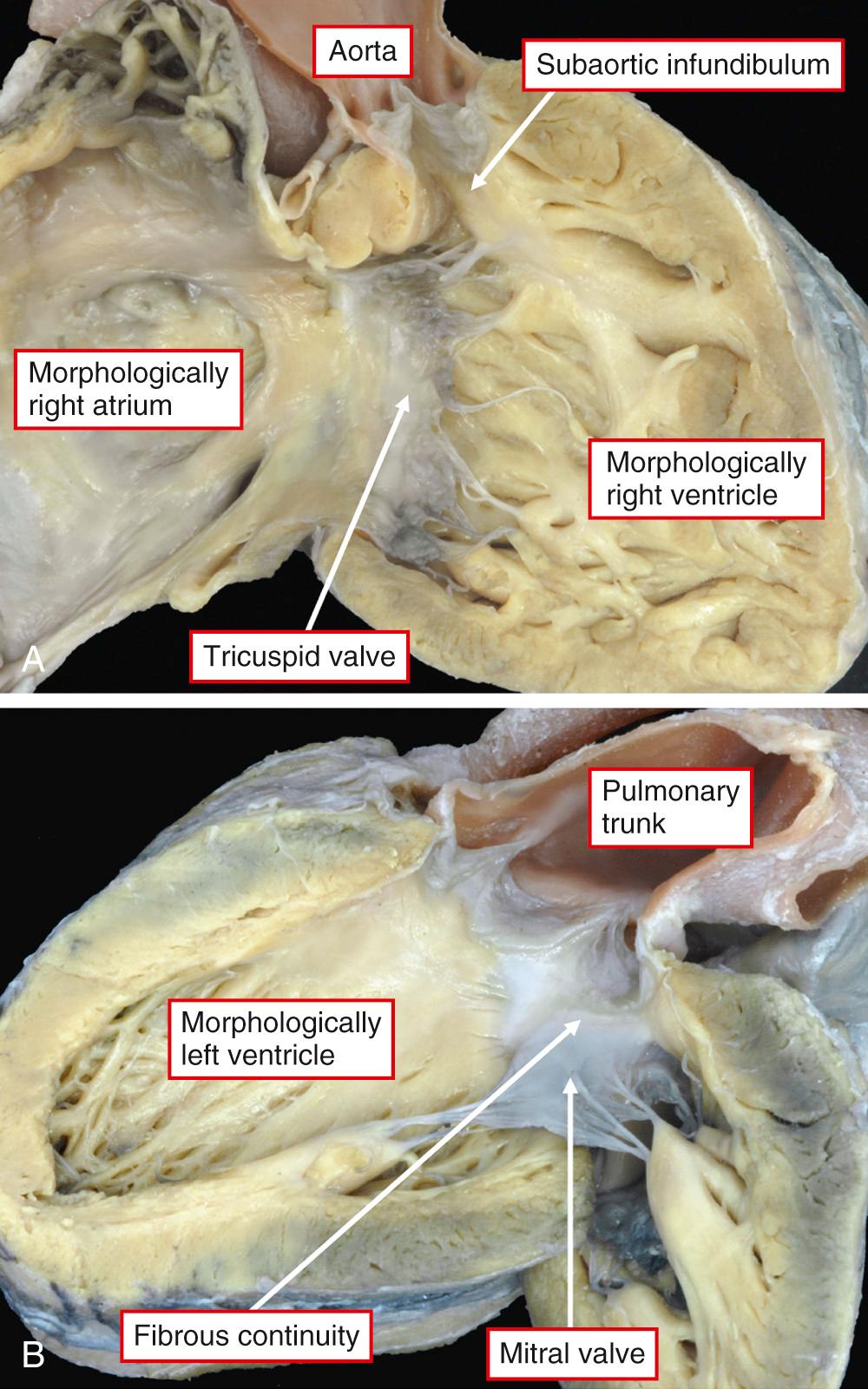 Fig. 37.2, (A) Morphologically right ventricle in the setting of transposition. It is connected by the tricuspid valve to the morphologically right atrium and supports the aorta above a muscular infundibulum. The ventricular septum is intact. (B) Morphologically left ventricle from the same heart. It is connected to the morphologically left atrium through a mitral valve and gives rise to the pulmonary trunk. Note the fibrous continuity between the leaflets of the pulmonary and mitral valves.