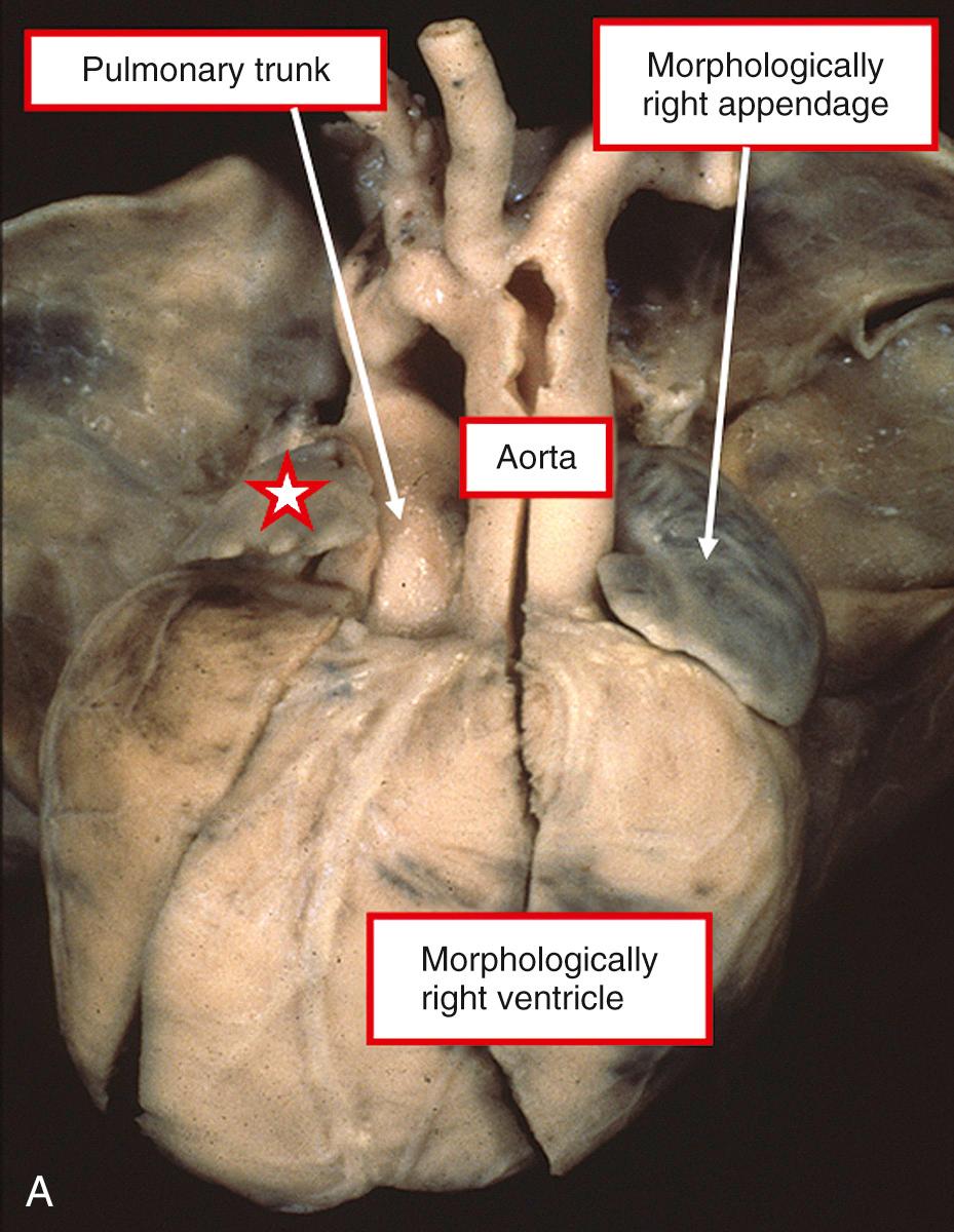 Fig. 37.3, Hearts from patients with transposition. (A) Patient with mirror-imaged atrial appendages. Note the left-sided morphologically right atrial appendage. The star shows the right-sided morphologically left appendage. There is left-hand ventricular topology, with the morphologically right ventricle being left sided, indicating the presence of concordant atrioventricular connections but with discordant ventriculoarterial connections. (B) In this patient the atrioventricular connections are concordant in the setting of usual atrial arrangement. The star shows that the morphologically right appendage is right sided. The discordantly connected aorta is to the left of the pulmonary trunk. Both of these hearts are examples of l-transposition that is not congenitally corrected.