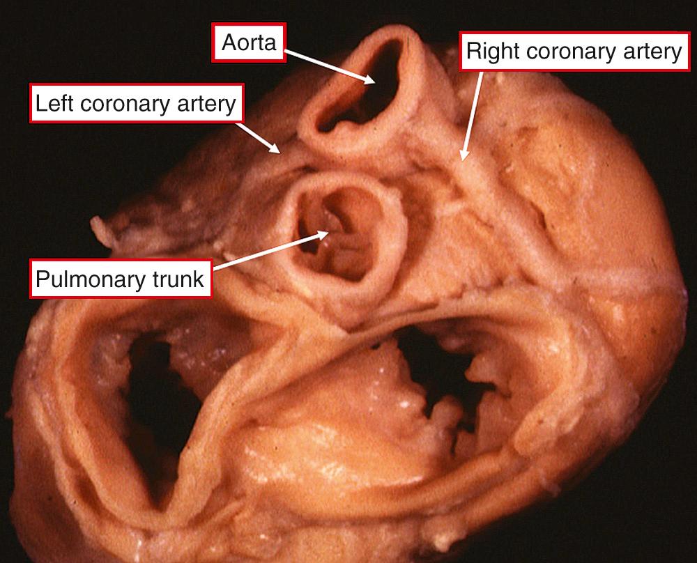 Fig. 37.4, Heart with atrial chambers and arterial trunks removed, photographed from the atrial aspect. Note the anterior and right-sided location of the discordantly connected aorta. As is always the case in the setting of transposition, the coronary arteries arise from the aortic sinuses adjacent to the pulmonary trunk, in this instance with one coronary artery arising from each sinus.