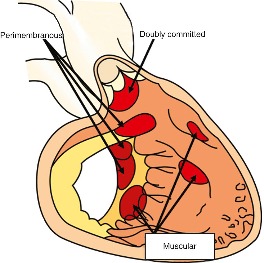 Fig. 37.6, As is the case with interventricular communications in the otherwise normal heart, those found in patients with transposition can be characterized as being muscular, perimembranous, or doubly committed. The muscular defects can be positioned to open to the inlet, the apical component, or the outlet of the right ventricle. Perimembranous communications are central, but they, too, can extend to open to the right ventricular inlet or outlet, the latter in the setting of malalignment between the apical septum and the outlet septum.