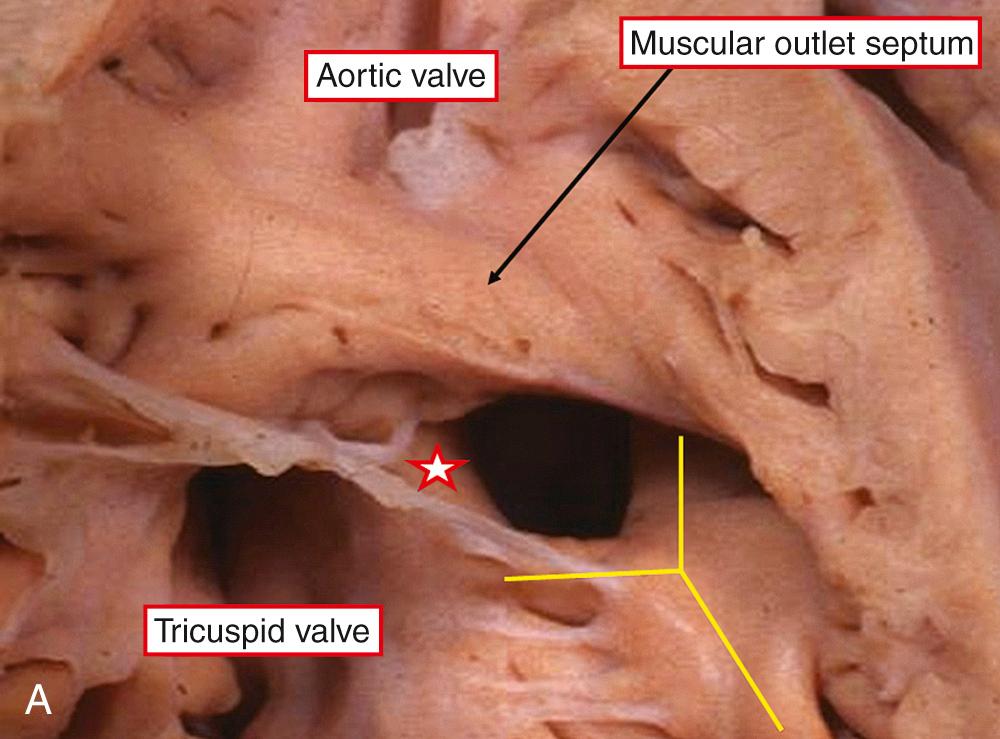 Fig. 37.7, Ventricular septal defects in the setting of transposition with malalignment between the outlet septum and apical septum. (A) The outlet septum is malaligned to the right, opening to the right ventricle between the limbs of the septomarginal trabeculation (yellow bars). Note the muscular posteroinferior rim to the defect (star) . (B) In this ventricular septal defect viewed anteriorly and from the left side, the outlet septum is malaligned posteriorly into the left ventricle and obstructs the subpulmonary outflow tract. VSD , Ventricular septal defect.