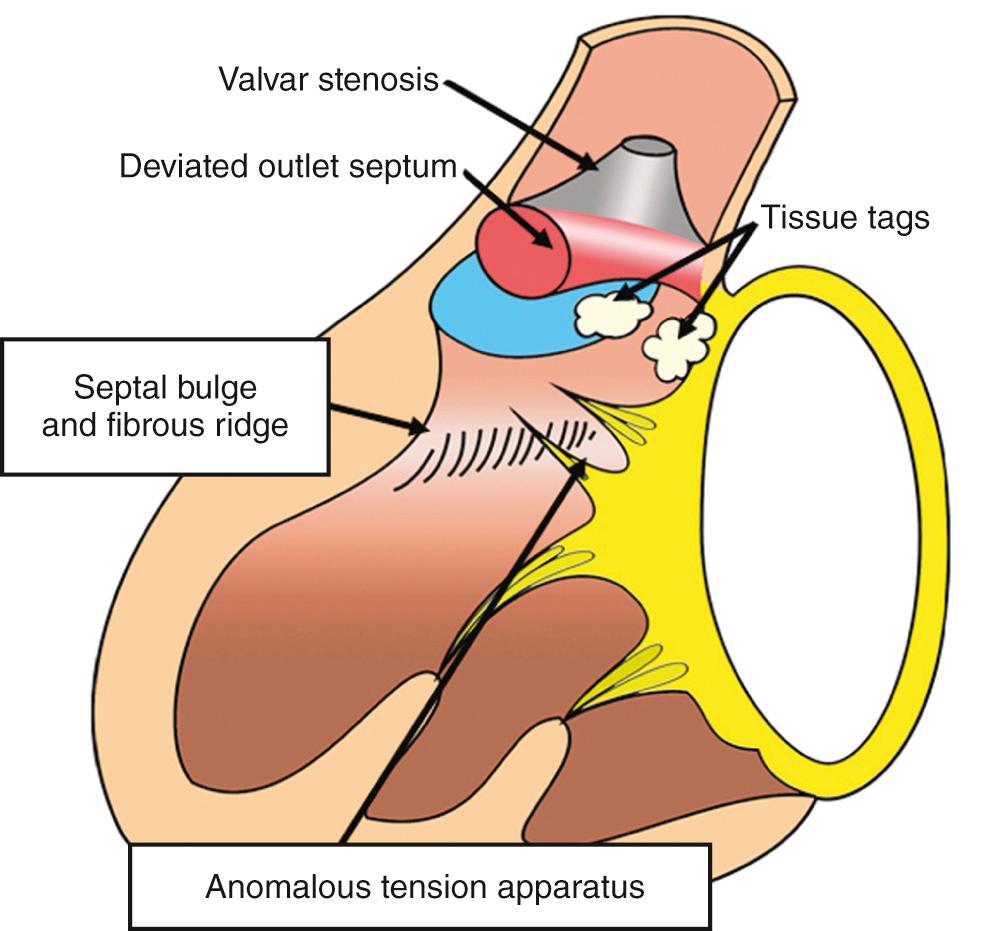 Fig. 37.8, Substrates producing subpulmonary stenosis in transposition. The lesions are the same as those that produce subaortic stenosis when the ventriculoarterial connections are concordant.