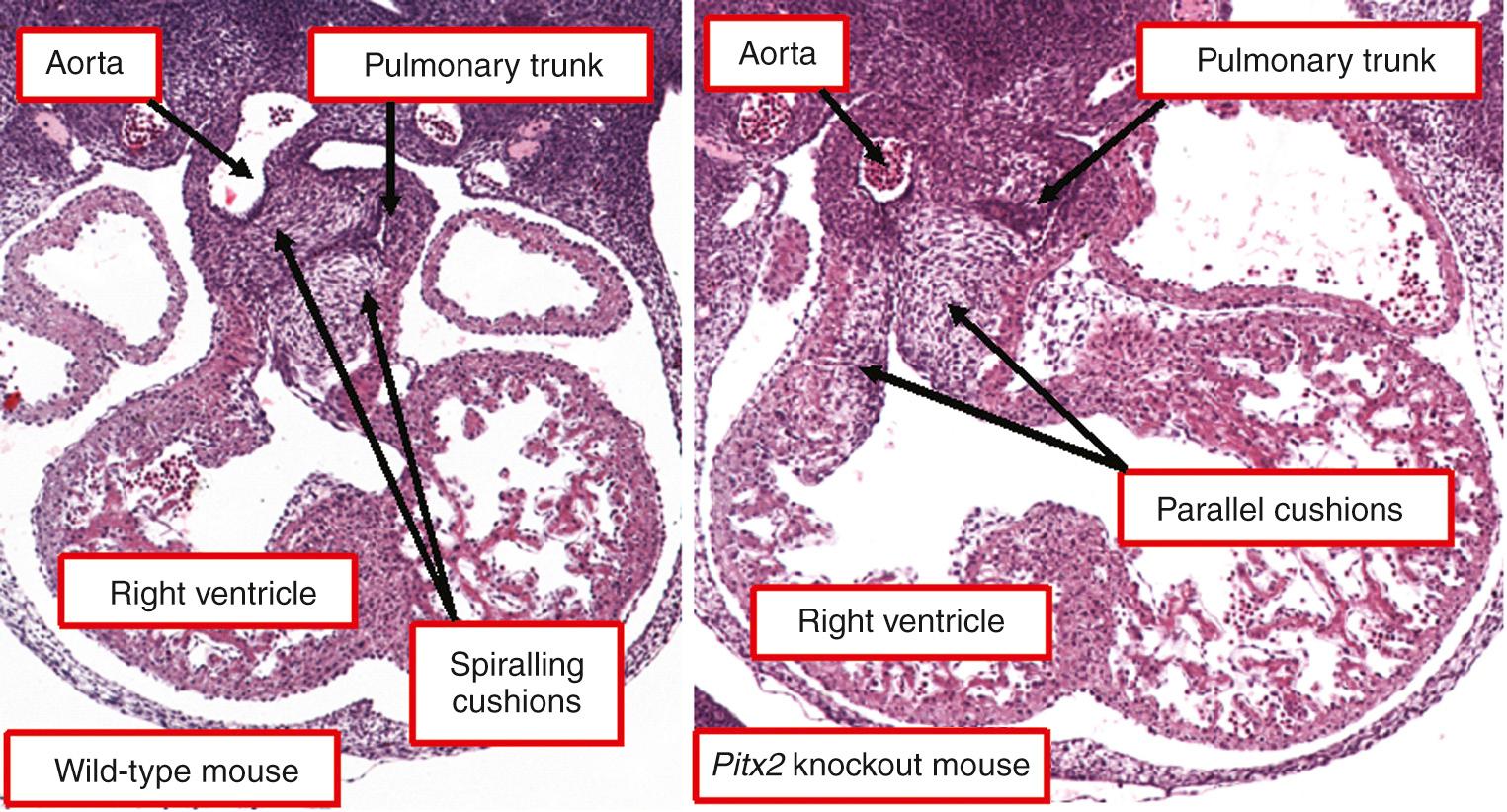 Fig. 37.9, Frontal sections from a wild-type mouse (left) and a Pitx2 knockout mouse (right) at comparable stages of development. They illustrate the markedly different orientation of the cushions in the developing outflow tract. The knockout mice proceed to develop either discordant ventriculoarterial connections or double-outlet right ventricle with subpulmonary interventricular communication because it is the subpulmonary component of the proximal outflow tract, rather than the subaortic component as in the wild-type mouse, that is transferred to the developing left ventricle.