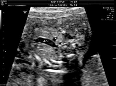 Fig. 86.4, Abnormal three-vessel and trachea view in which only the aorta (Ao), the superior cava vein (SCV), and the trachea can be identified (asterisk) .