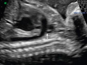 Fig. 86.5, Longitudinal view of the aortic arch emerging from the anterior ventricle. Note the hockey-stick shape and the supraaortic branching (arrow) far from the semilunar valve.