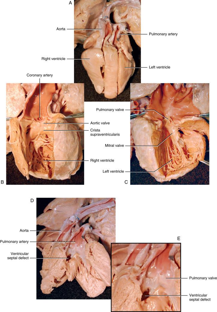 Figure 22-1, A Transposition of the great arteries, external view. The aorta originates from the right ventricle (ventriculoarterial discordant connection). It is anterior and to the right of the pulmonary artery, which arises from the left ventricle. B Transposition of the great arteries, right ventricular view. The heavily trabeculated anatomic right ventricle is enlarged and hypertrophied. The right ventricular outflow tract, with its well-defined crista supraventricularis and ventricular infundibular fold, is in continuity with the aorta. The ostia of the coronary arteries confirm that this is the aorta. The aortic valve is normal. C Transposition of the great arteries, left ventricular view. The finely trabeculated left ventricle is in continuity with the pulmonary trunk. The pulmonary valve is continuous with the mitral valve. The left ventricle has a thin wall because it pumps blood to the low-pressure pulmonary circulation. D Transposition of the great arteries with ventricular septal defect. The aorta originates anteriorly from the right ventricle. The pulmonary trunk arises from the left ventricle and is located posterior to and to the left of the aorta. There is a ventricular septal defect in the membranous portion of the septum. The left ventricle is hypertrophied. E Transposition of the great arteries with ventricular septal defect, magnified view. This view shows details of the close relationship between the ventricular septal defect and the pulmonary valve. The pulmonary valve is normal.