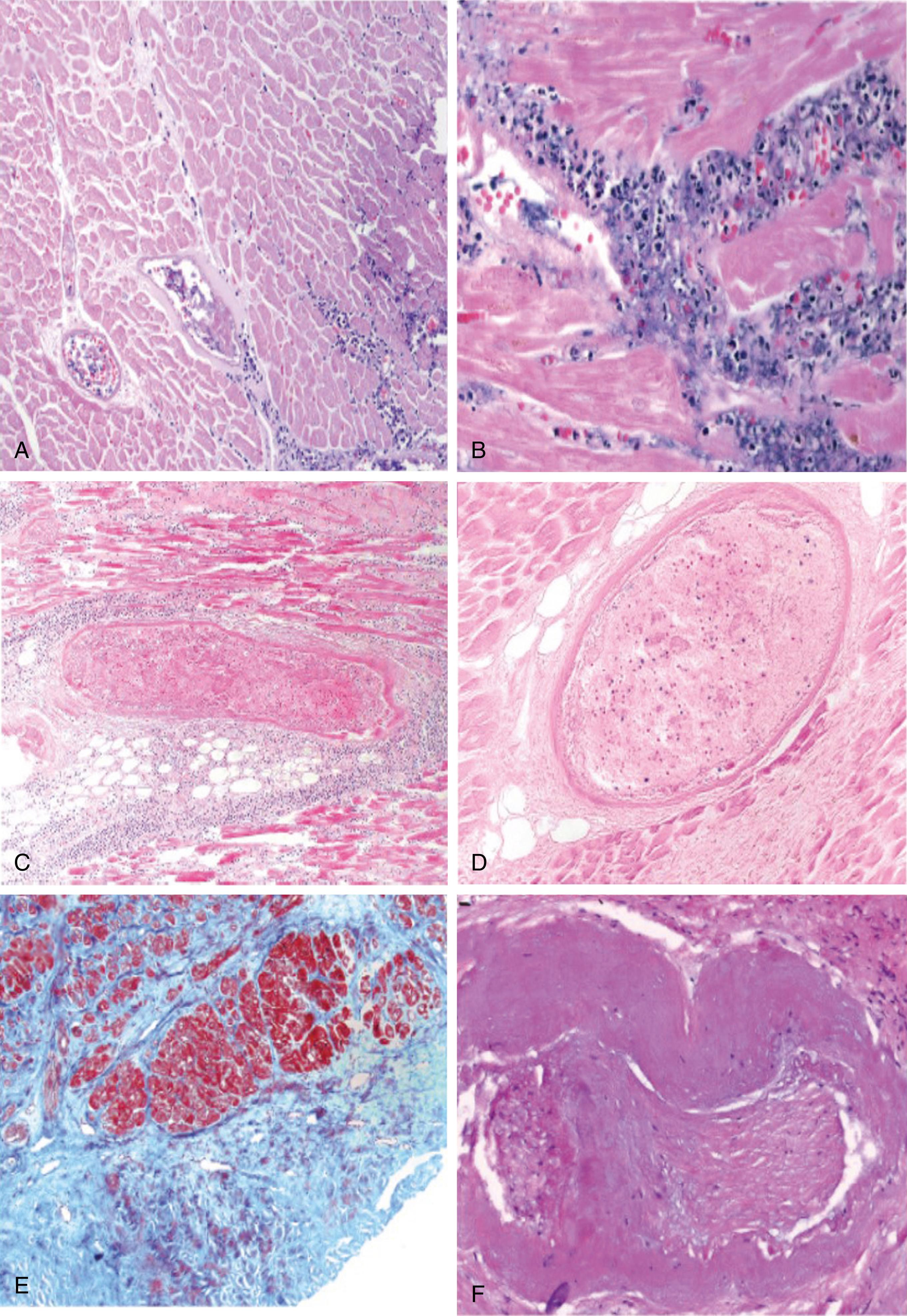 Fig. 132.1, Pathologic examination after intracoronary administration of ethanol for alcohol septal ablation for the management of hypertrophic obstructive cardiomyopathy.