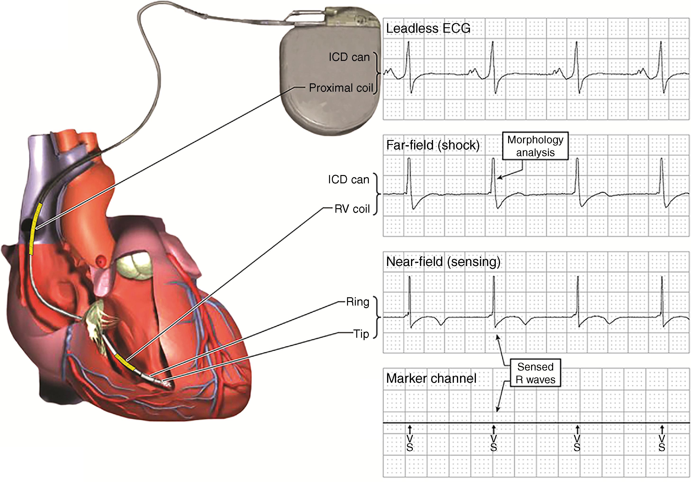 Fig. 122.2, Implantable cardioverter-defibrillator (ICD) leads and electrograms (EGMs).