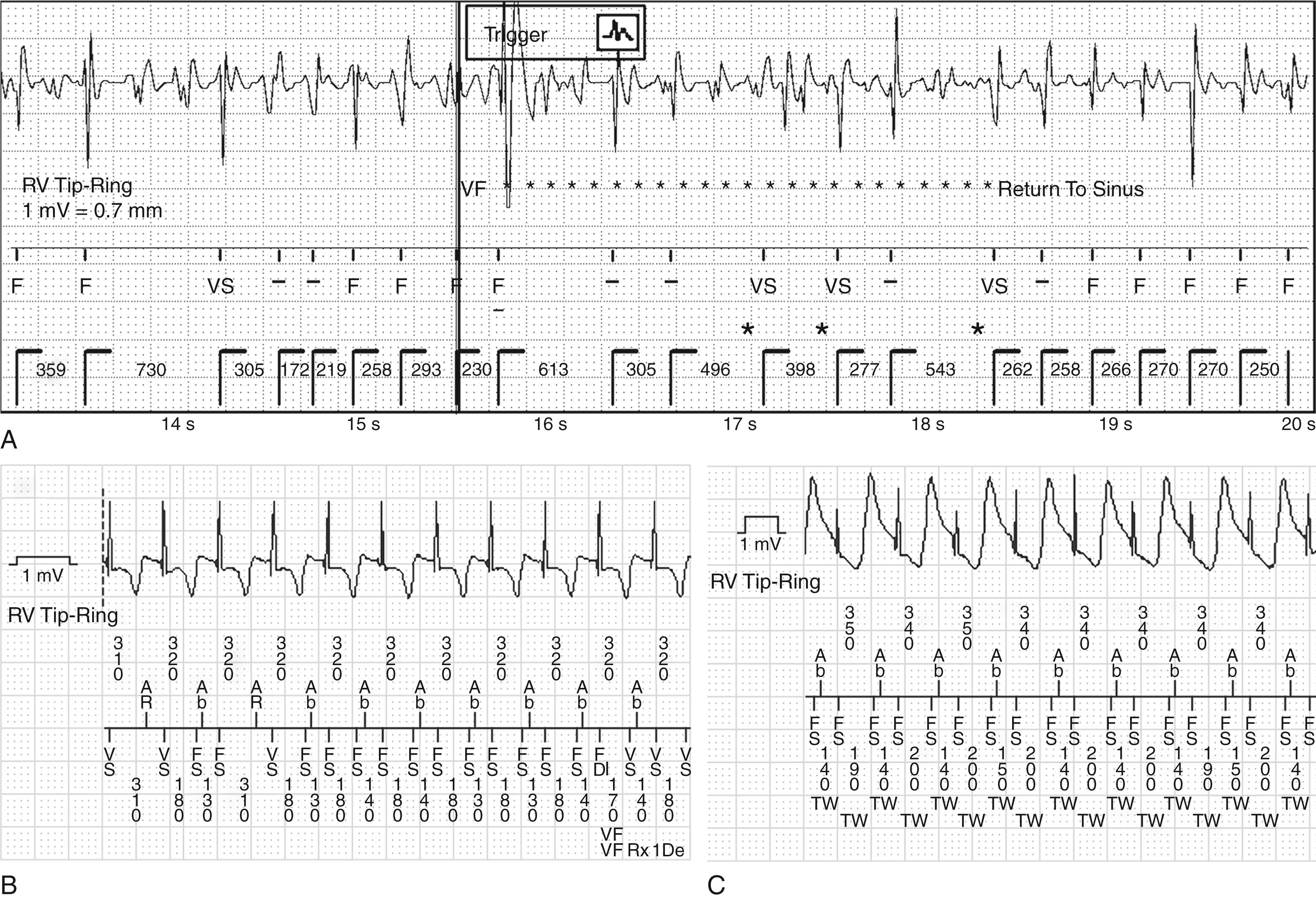 Fig. 122.3, Undersensing and oversensing.