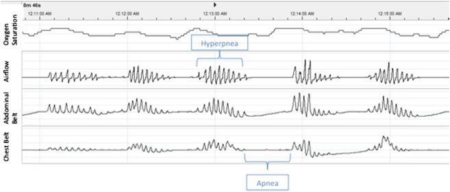 Figure 110.1, Example of central sleep apnea with periods of absent breathing (apnea) and rapid breathing (hyperpnea).