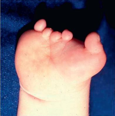 FIG. 5.4.1, Transverse deficiency at the level of the metacarpals, with a relatively preserved thumb. Rudimentary digital structures, or “nubbins,” are located at the terminal aspect of the limb and can be found in more proximal transverse deficiencies as well.