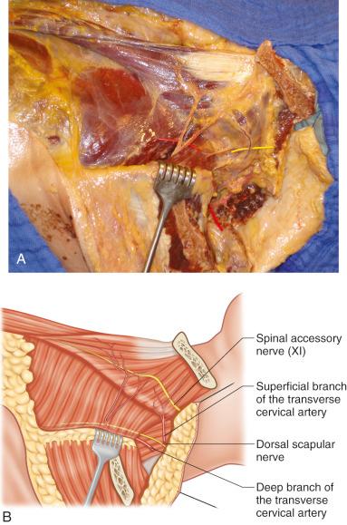 Figure 39.3, Lateral view of the right trapezius muscle after elevation of the lateral aspect of the muscle. (A) Cadaver dissection. (B) Descriptive diagram of (A).