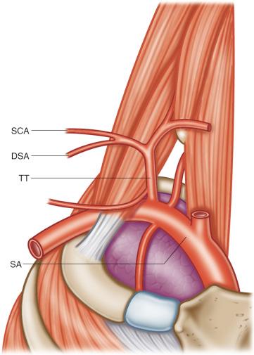 Figure 39.5, The most frequent origin (30%) of the dorsal scapular artery (DSA) is from a common trunk with the superficial cervical artery (SCA). This trunk, usually called the transverse cervical artery, may come from the thyrocervical trunk (TT) (16%) or directly from the lateral part of the subclavian artery (SA) (14%).
