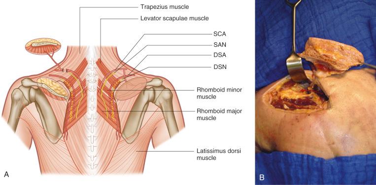 Figure 39.6, Elevated osteomyocutaneous flap based on the ascending branch of the superficial scapular artery. (A) Schematic drawing: SCA, superficial cervical artery; SAN, spinal accessory nerve; DSA, dorsal scapular artery; DSN, dorsal scapular nerve. (B) Cadaver dissections.