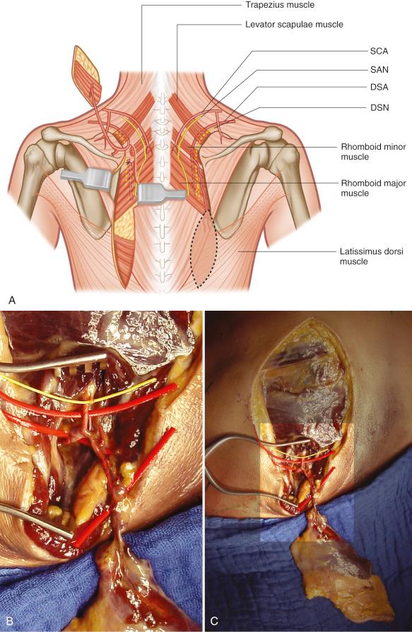 Figure 39.7, Elevated myocutaneous flap based on the dorsal scapular artery. (A) Schematic drawing: SCA, superficial cervical artery; SAN, spinal accessory nerve; DSA, dorsal scapular artery; DSN, dorsal scapular nerve. (B) Cadaver dissections.