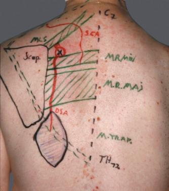 Figure 39.9, Anatomic landmarks and flap markings. Typical preoperative markings preparatory to a myocutaneous flap based on the DSA.