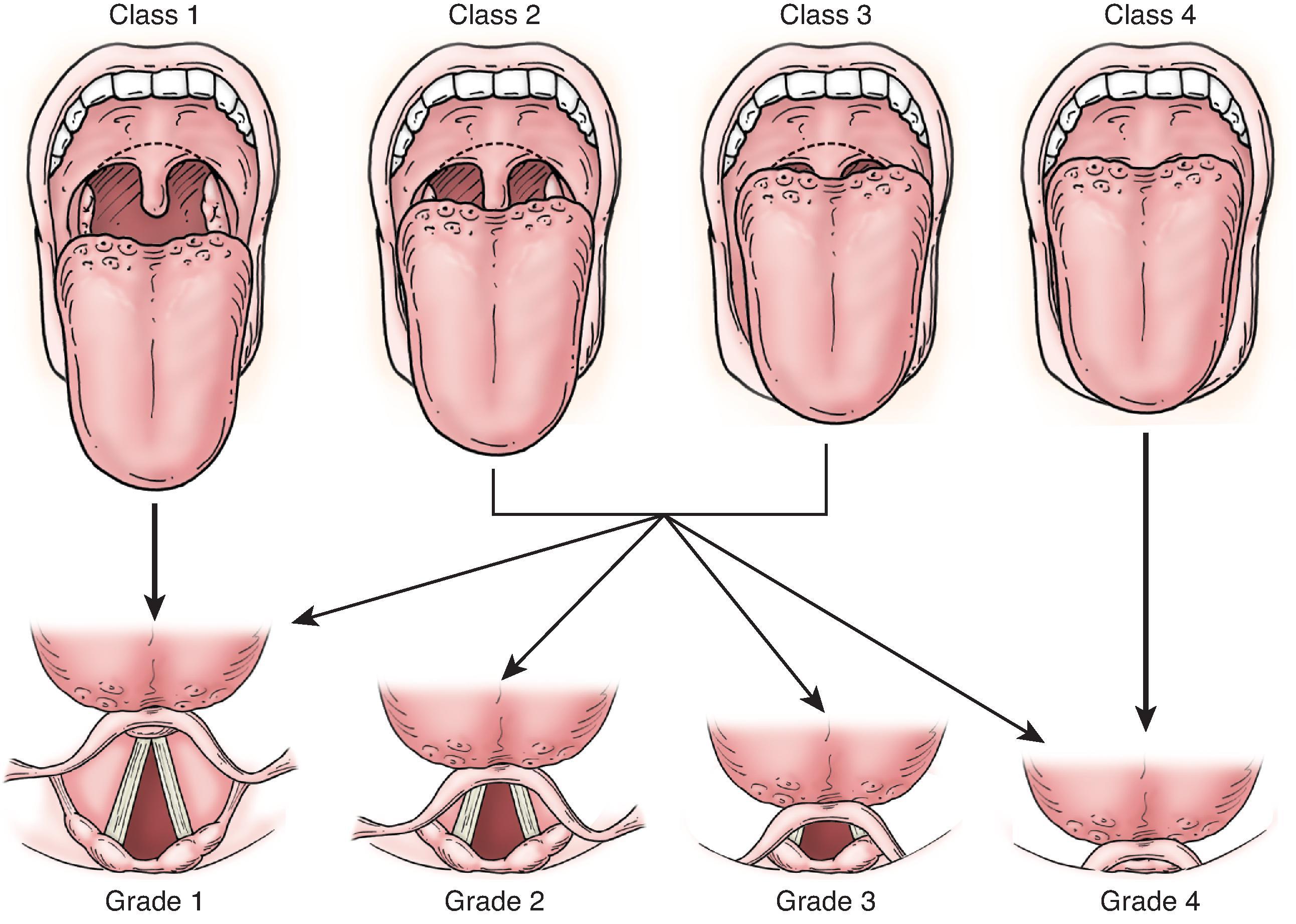 FIG. 2, The Mallampati classification. The higher the class, the worse the Cormack-Lehane view of the vocal cords during direct laryngoscopy. (From Lalwani AK, ed. Current Diagnosis and Treatment in Otolaryngology: Head and Neck Surgery . 2nd ed. New York: McGraw-Hill; 2007.)