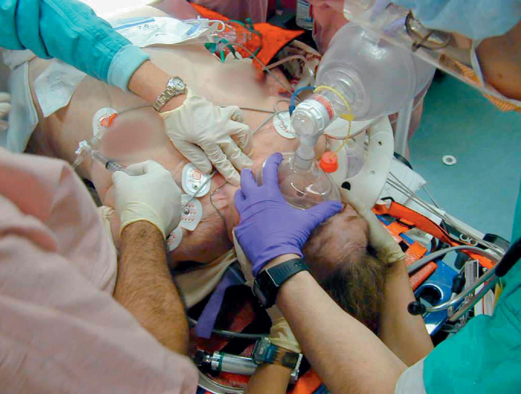 FIG. 3, Four providers are recommended for securing the airway. Providers are assigned to (1) ventilate with the bag-valve mask and intubate, (2) maintain in-line cervical stabilization, (3) administer cricoid pressure, and (4) administer drugs and assist with airway devices.