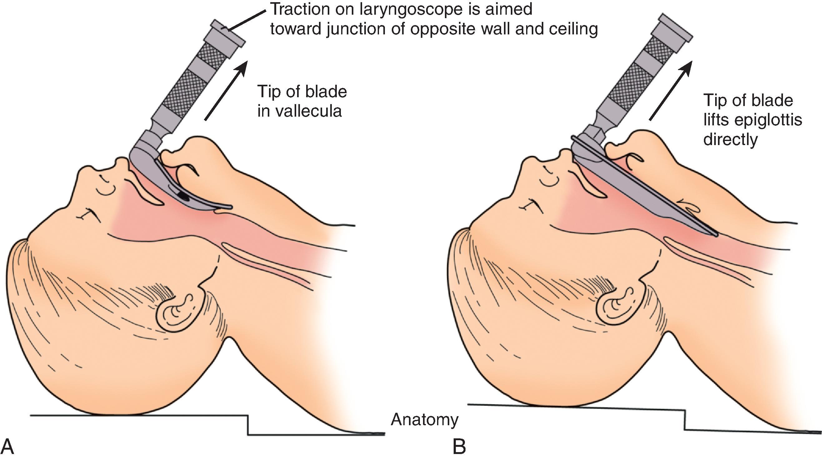 FIG. 4, (A) MacIntosh blade. (B) McGill blade. It should be noted that the patient in this figure does not have cervical spine precautions; in the majority of patients, manual in-line stabilization must be performed during intubation attempts to prevent exacerbation of neurologic damage.