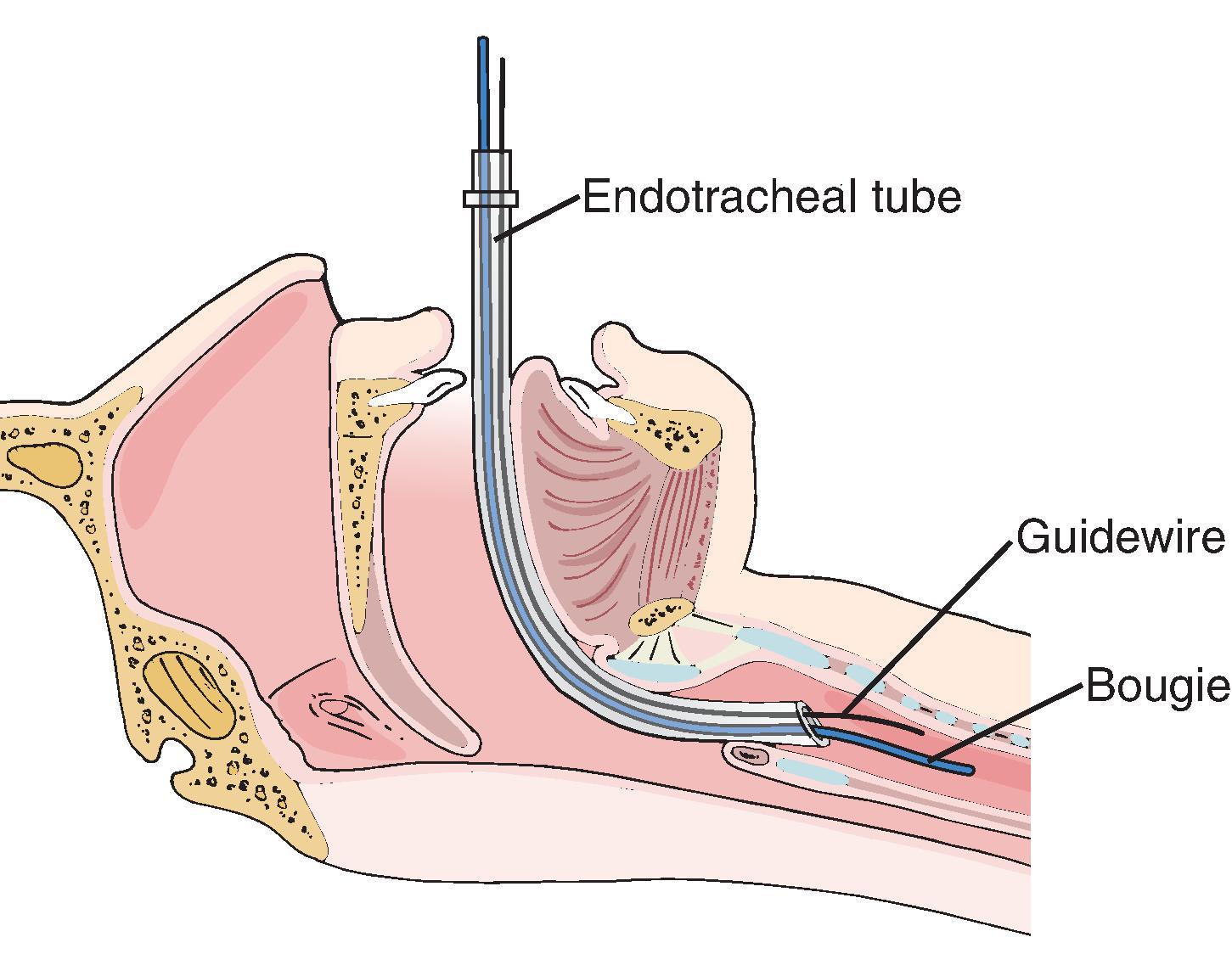 FIG. 5, Gum elastic bougie insertion. See text for explanation. (From Sandberg MD et al. The MGH Textbook of Anesthetic Equipment . Philadelphia: Elsevier; 2010.)
