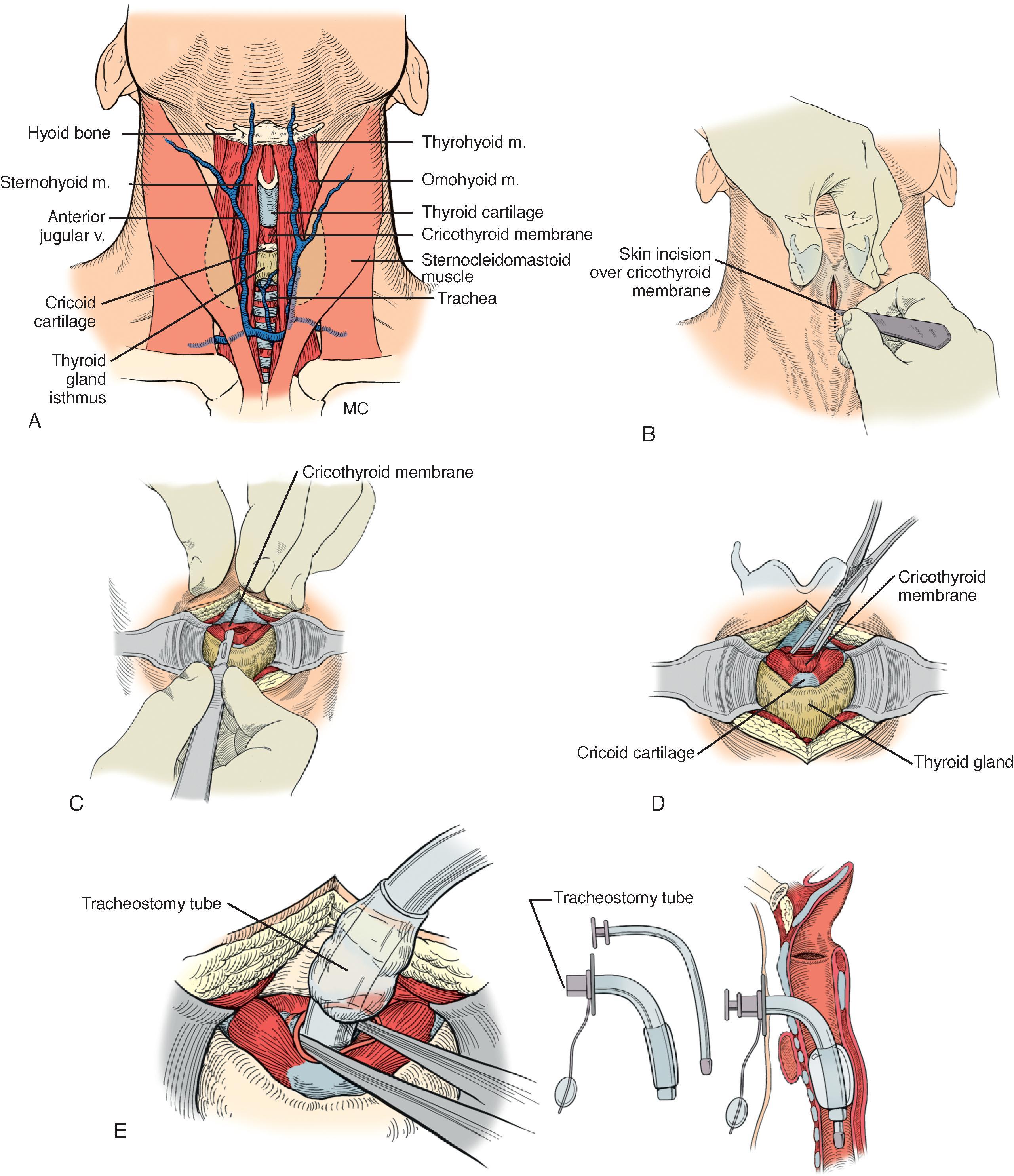 FIG. 7, Cricothyroidotomy. (A) The cricothyroid membrane is located between the thyroid cartilage above and the cricoid ring below. (B) The operator’s nondominant hand holds the thyroid cartilage, while the other hand performs the procedure. A vertical skin incision avoids the anterior jugular vein to minimize bleeding. (C) The cricothyroid membrane is incised transversely. (D) The opening is widened with a small hemostat. (E) The tracheostomy tube is placed into the airway, and the cuff is inflated.