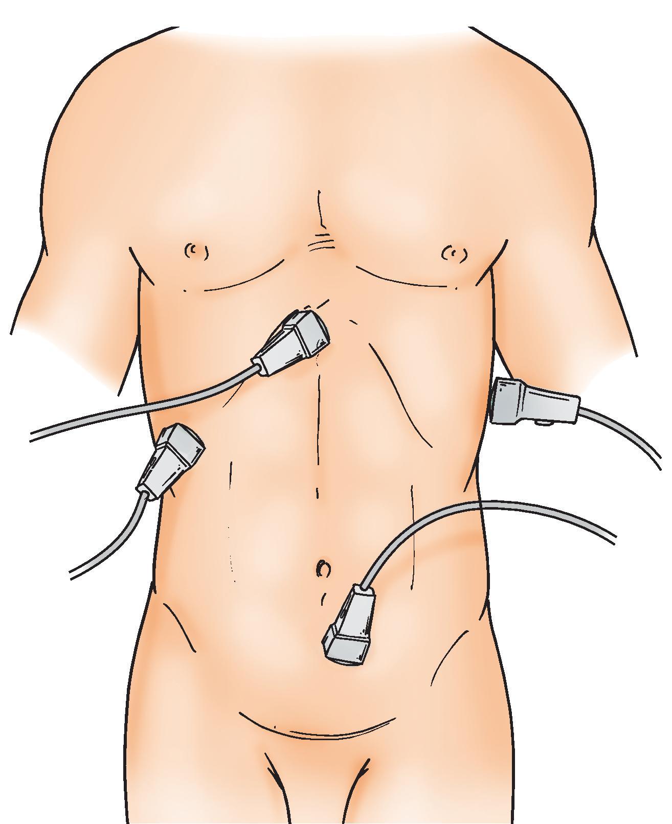 FIG. 1, Transducer positions for FAST: pericardial, right upper quadrant, left upper quadrant, and pelvis.