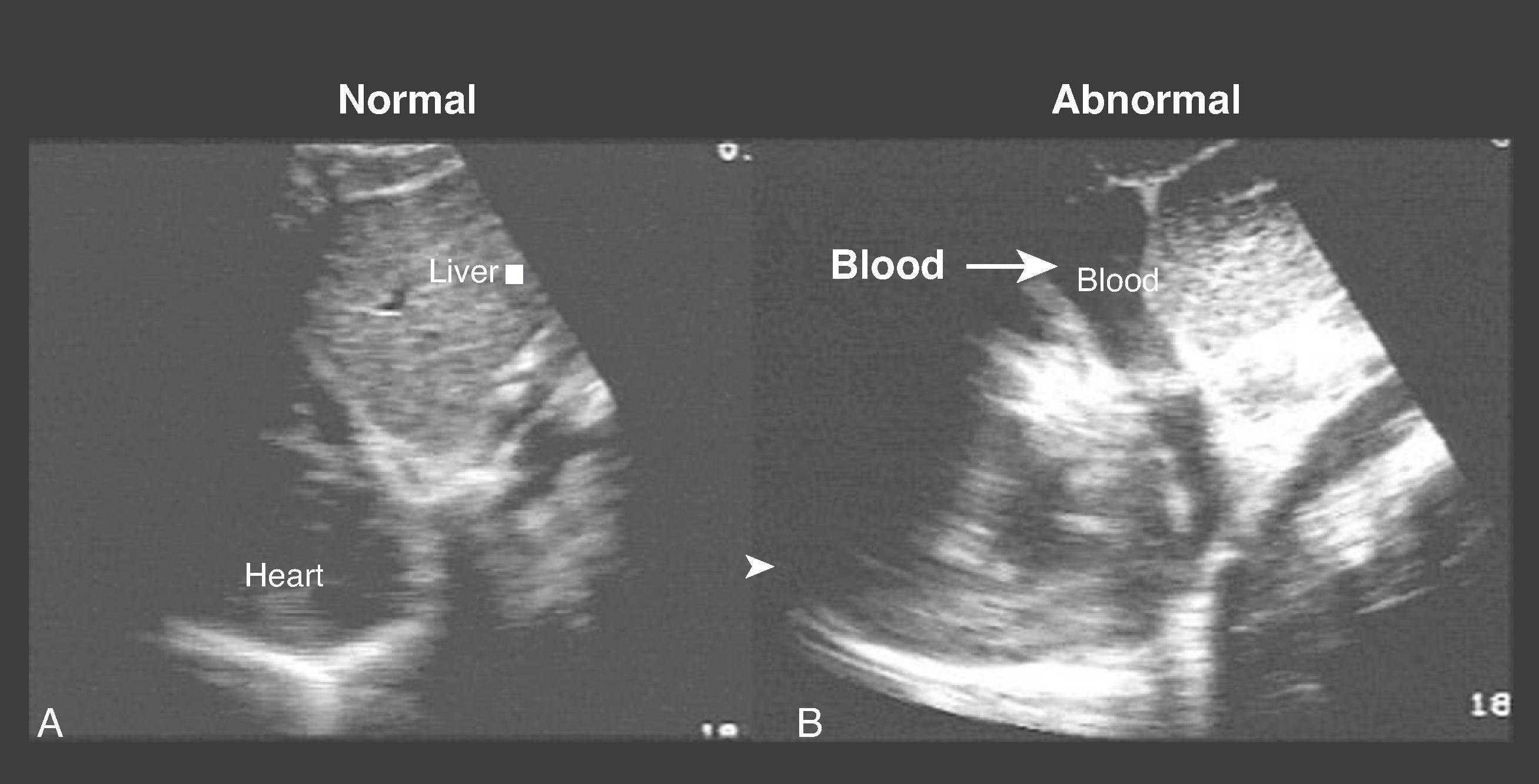 FIG. 2, (A) Normal sagittal view of pericardial area showing pericardium as single echogenic line. (B) Abnormal sagittal view of pericardial area showing separation of visceral and parietal areas of pericardium with blood (arrow) that appears anechoic .