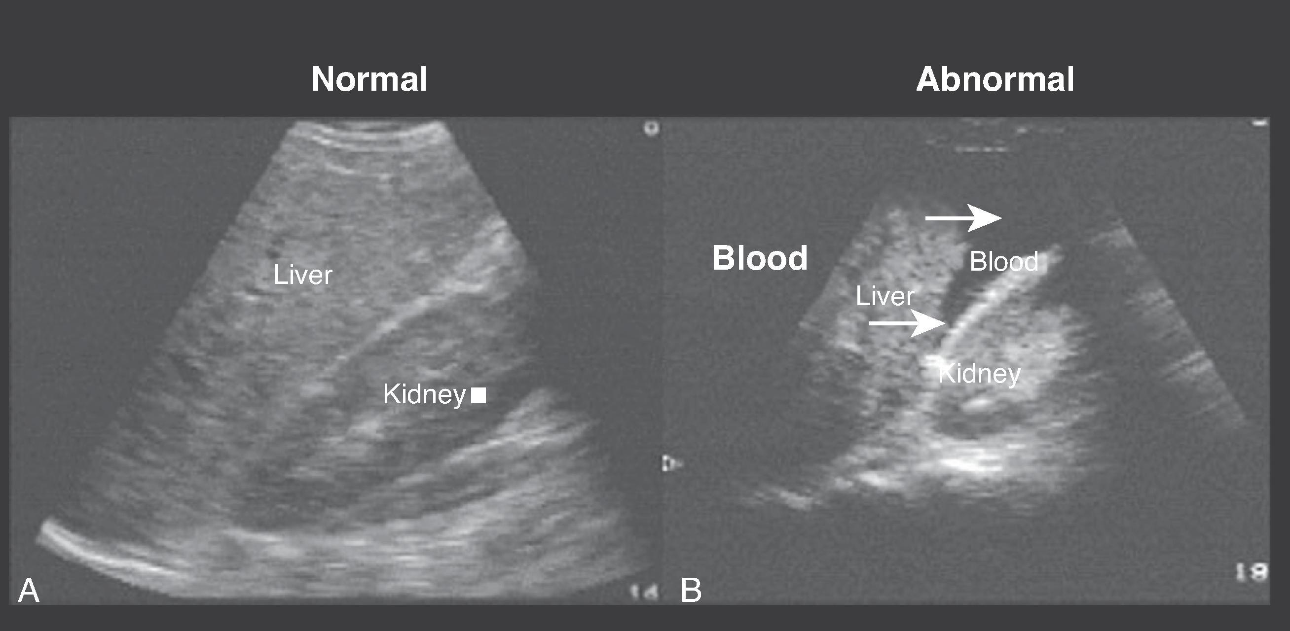 FIG. 3, (A) Normal sagittal view of liver, kidney, and diaphragm . Note Gerota’s fascia is hyperechoic. (B) Abnormal sagittal view of liver, kidney, and diaphragm. Note fluid (blood) between liver and kidney (arrows).