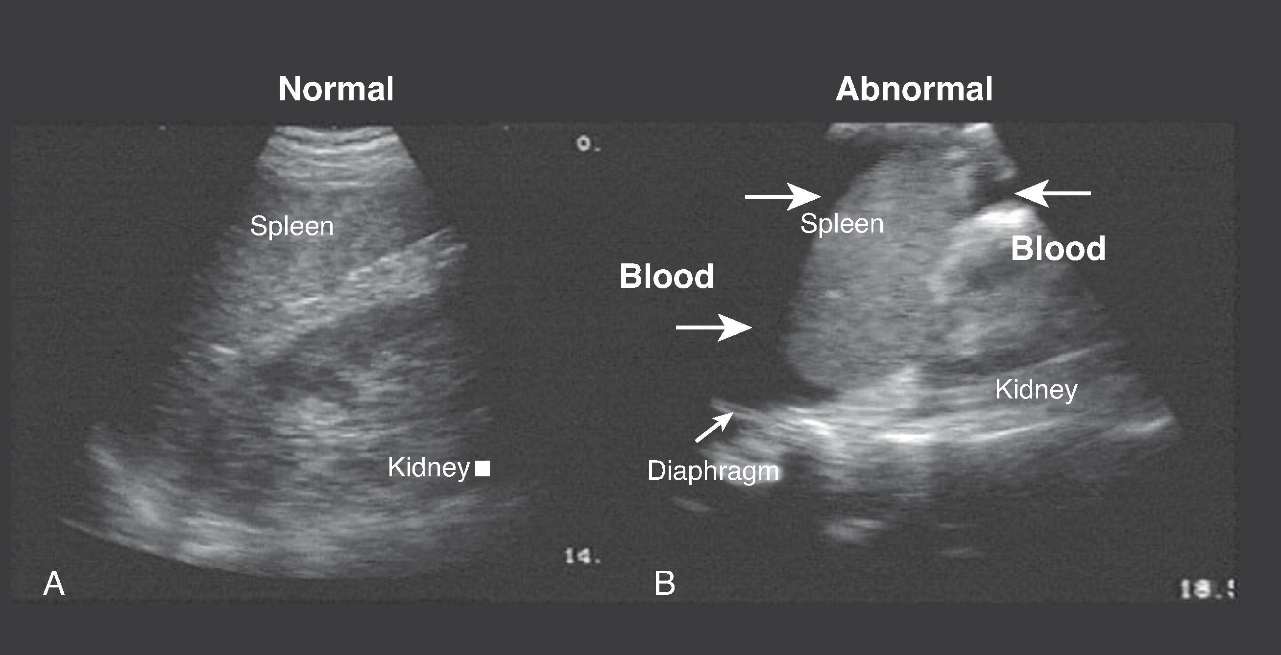 FIG. 4, (A) Normal sagittal view of spleen, kidney, and diaphragm. (B) Abnormal sagittal view of spleen, kidney, and diaphragm with fluid (blood) between spleen and kidney and above the spleen in the subphrenic space (arrows).