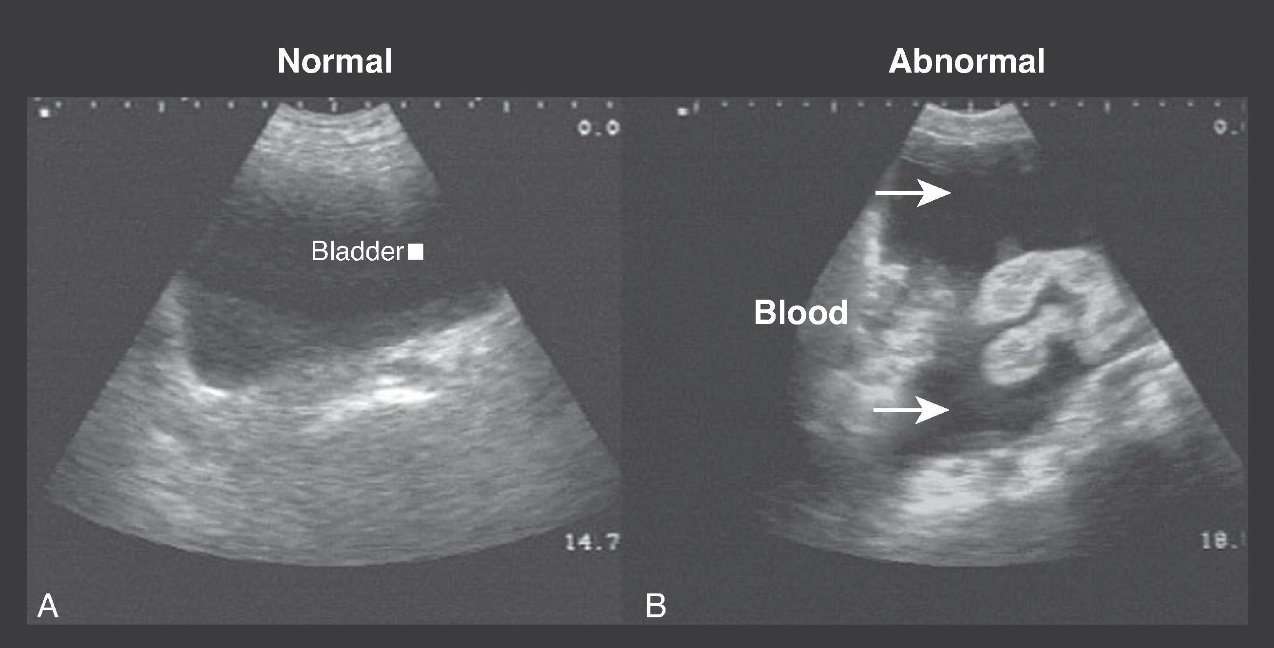 FIG. 5, (A) Normal coronal view of full urinary bladder . (B) Abnormal coronal view of full bladder with fluid in pelvis . Note the bowel floating in fluid (arrows).