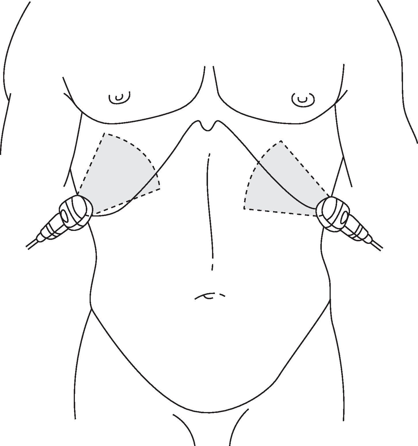 FIG. 6, Transducer positions for thoracic ultrasound examination (detection of hemothorax).