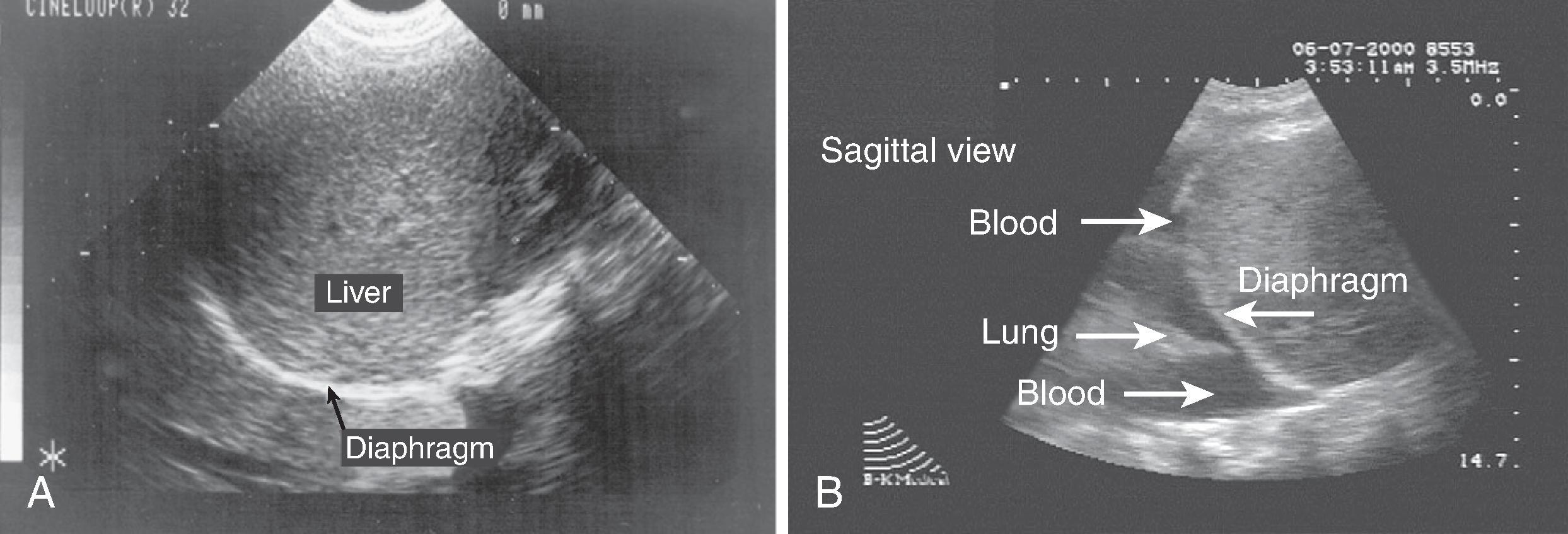 FIG. 7, (A) Sagittal view of liver, kidney, and diaphragm. Note supradiaphragmatic (lung) area but absence of pleural effusion. (B) Sagittal view of right supradiaphragmatic space. The right hemithorax contains fluid (blood), which appears anechoic.