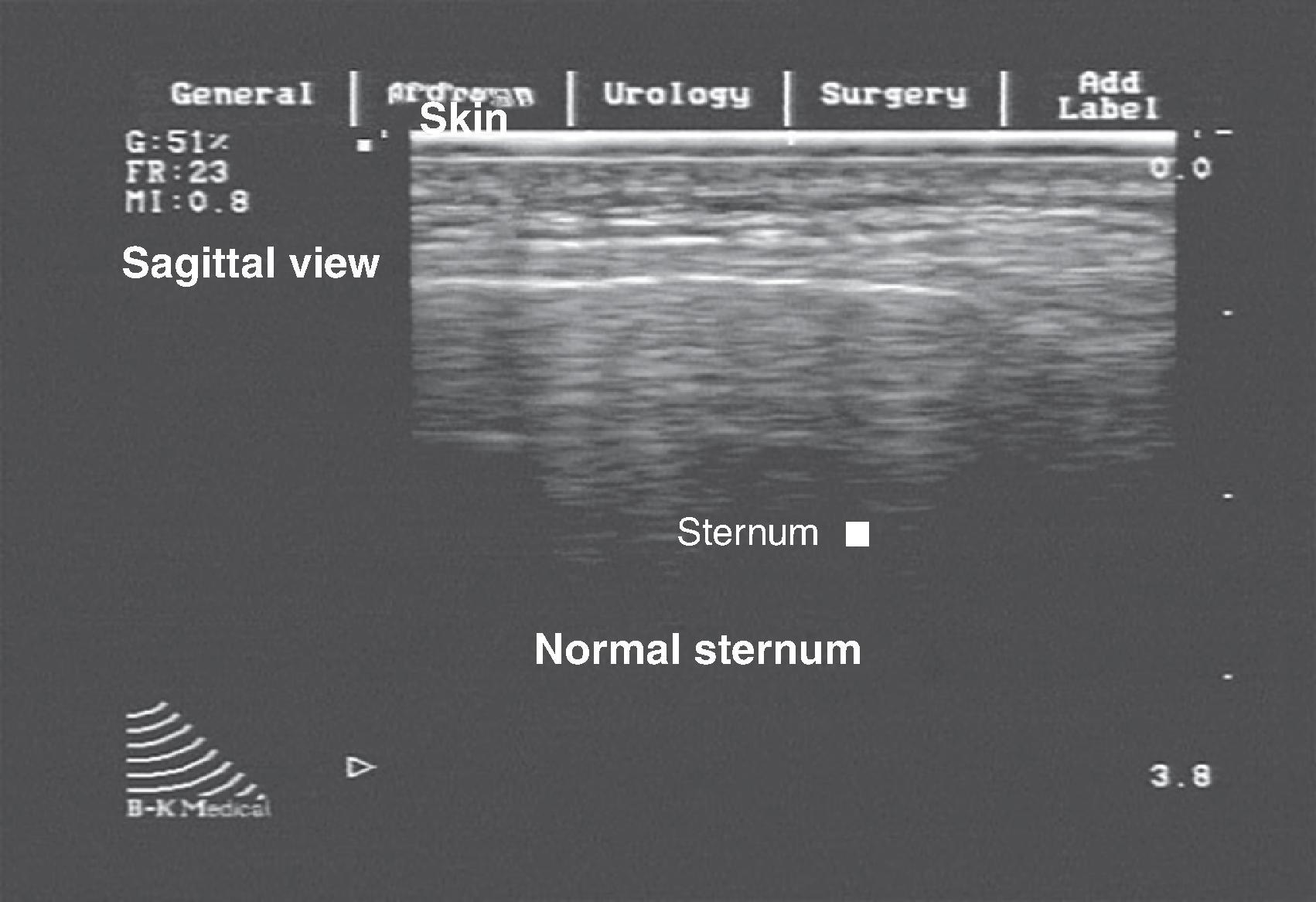 FIG. 9, Sagittal view of sternum illustrating normal findings.