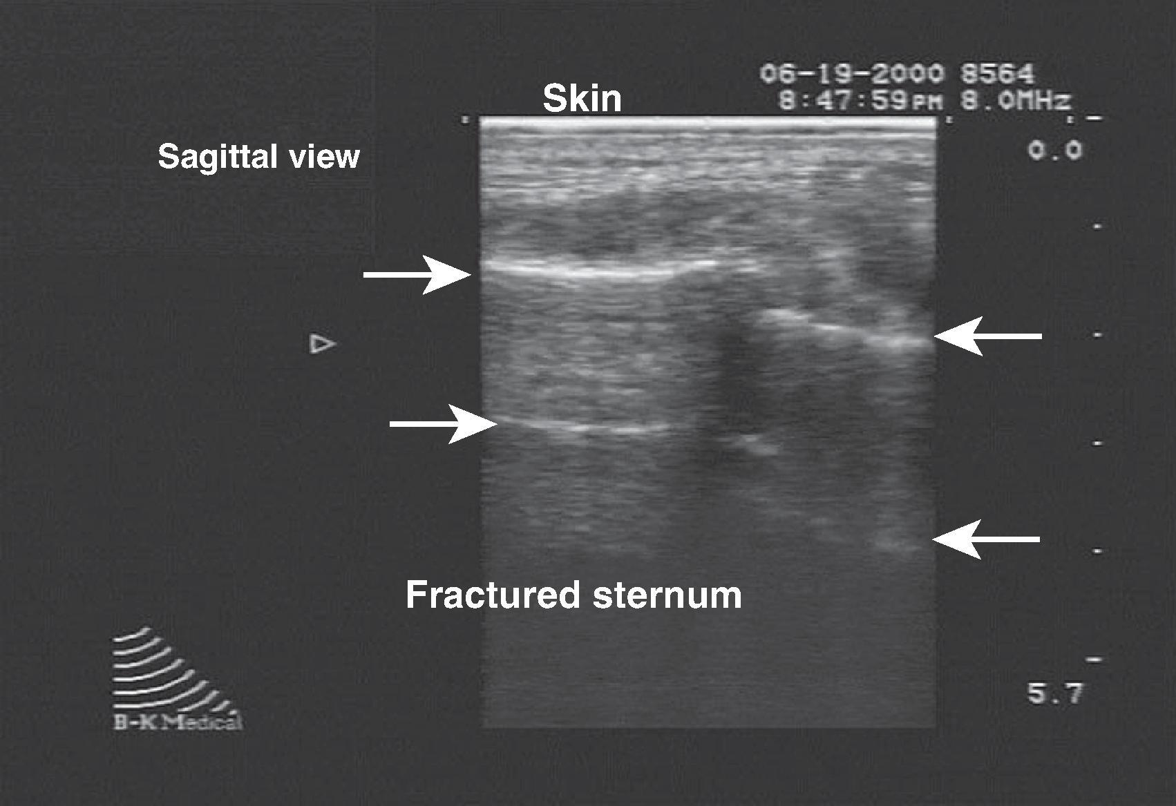 FIG. 10, Sagittal view of sternum illustrating fracture (interruption of hyperechoic line).