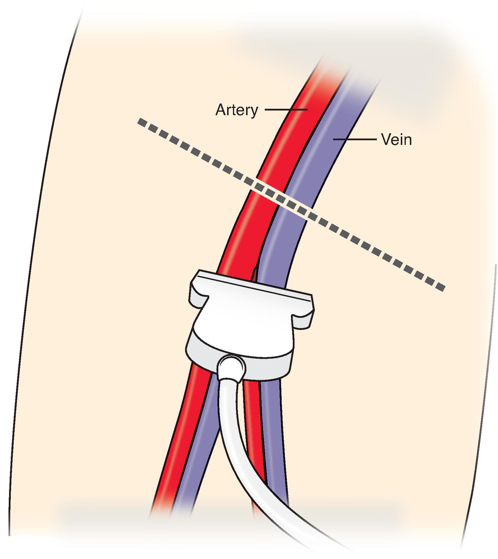 FIG. 11, Transducer positioning to interrogate the femoral vein.