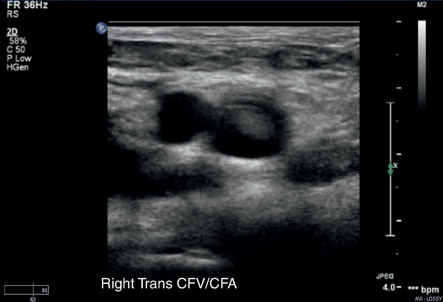 FIG. 12, Transverse image of hyperechoic material consistent with clot within the femoral vein. CFA, Common femoral artery; CFV, common femoral vein.