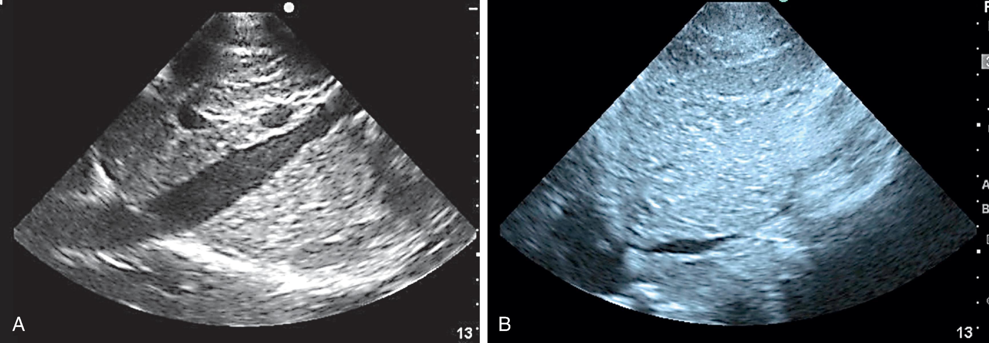 FIG. 13, (A) Longitudinal image of full vena cava. (B) Longitudinal image of collapsed vena cava.