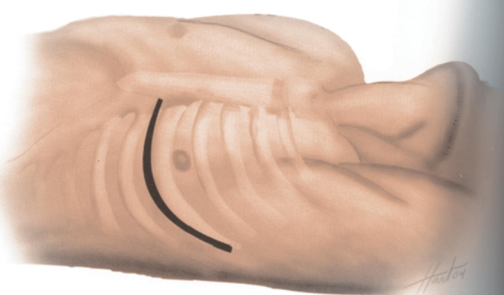 FIG. 1, Line of the left anterolateral thoracotomy; note that it follows the curve of the rib. The inframammary fold (in a woman) or the lower border of the nipple is a key landmark for sighting the incision.
