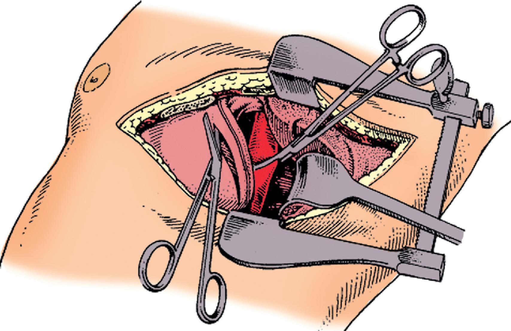 FIG. 2, The pericardiotomy is made anterior and parallel to the phrenic nerve. Note the clamp positioned across the thoracic aorta.