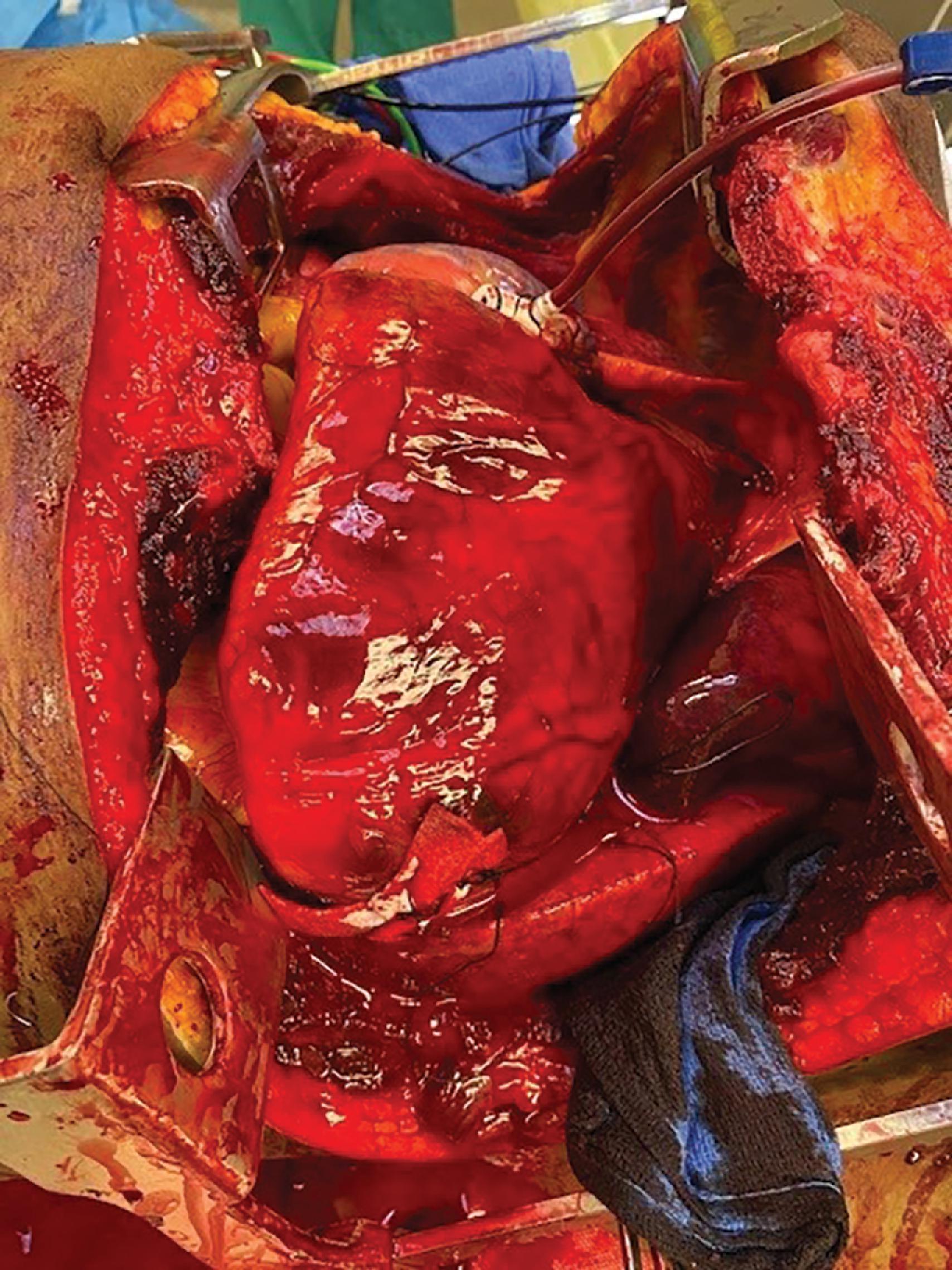 FIG. 3, Clamshell thoracotomy with the heart fully delivered from the pericardial sac. Note the pledgeted repair at the apex of the ventricle and the catheter placed in the atrium for resuscitation.