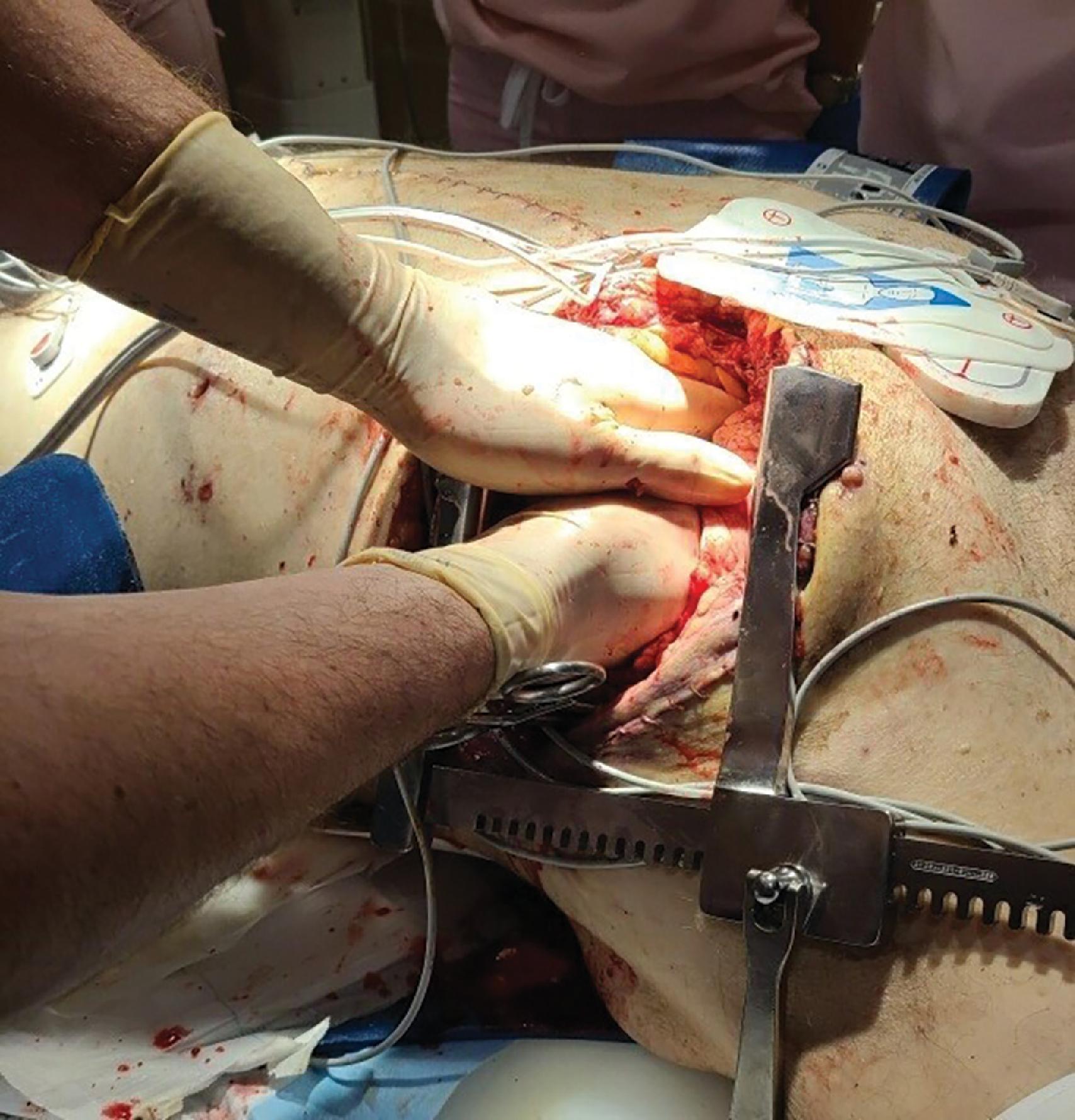 FIG. 4, Active cardiac massage precludes manual pressure on the intrathoracic aorta. Note aortic cross-clamp in place.