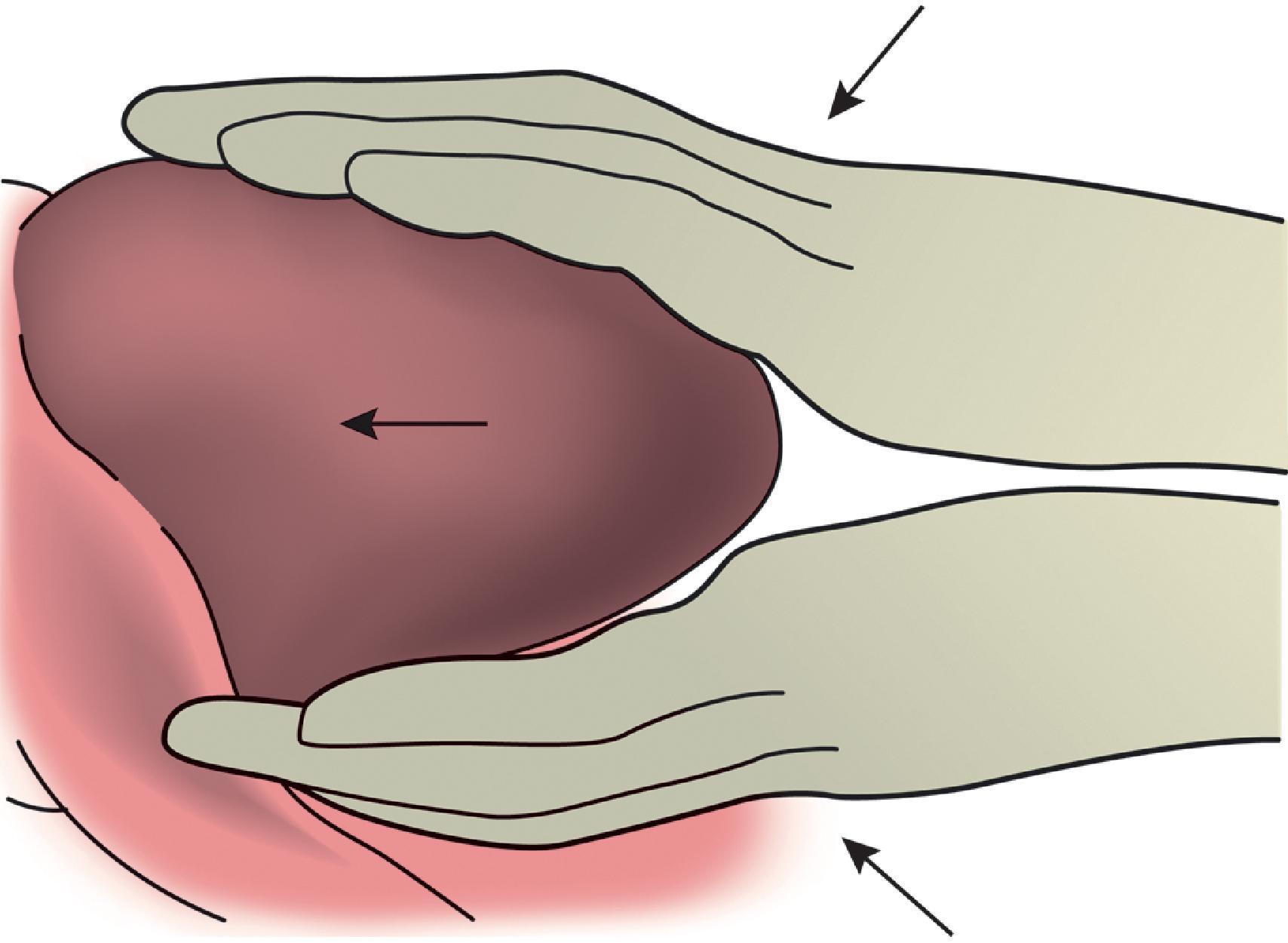 FIG. 5, Open cardiac massage is best achieved with a bimanual, open, flat-handed approach.