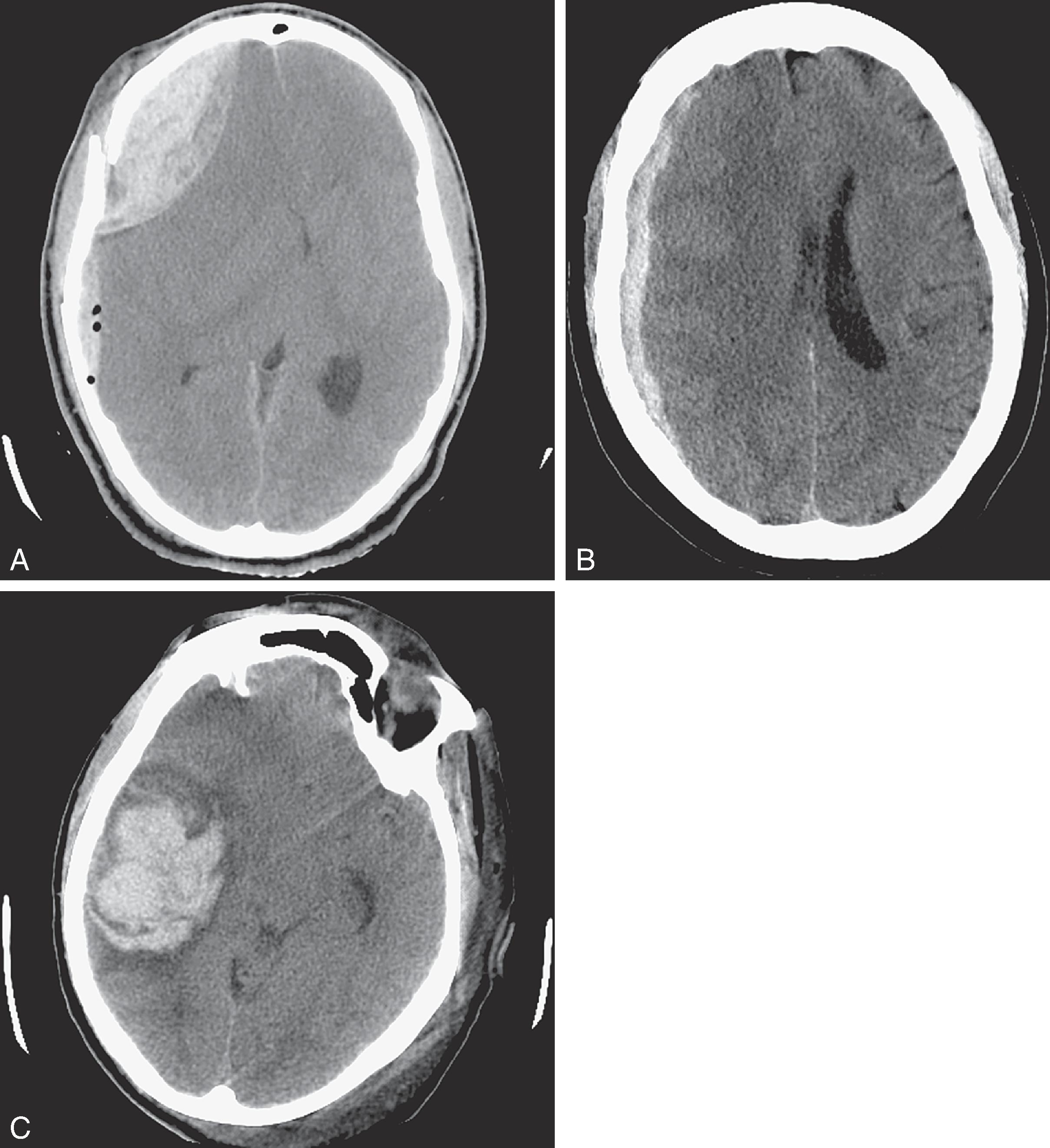 FIG. 2, (A) Epidural hematoma. (B) Subdural hematoma. (C) Traumatic intraparenchymal lesion.