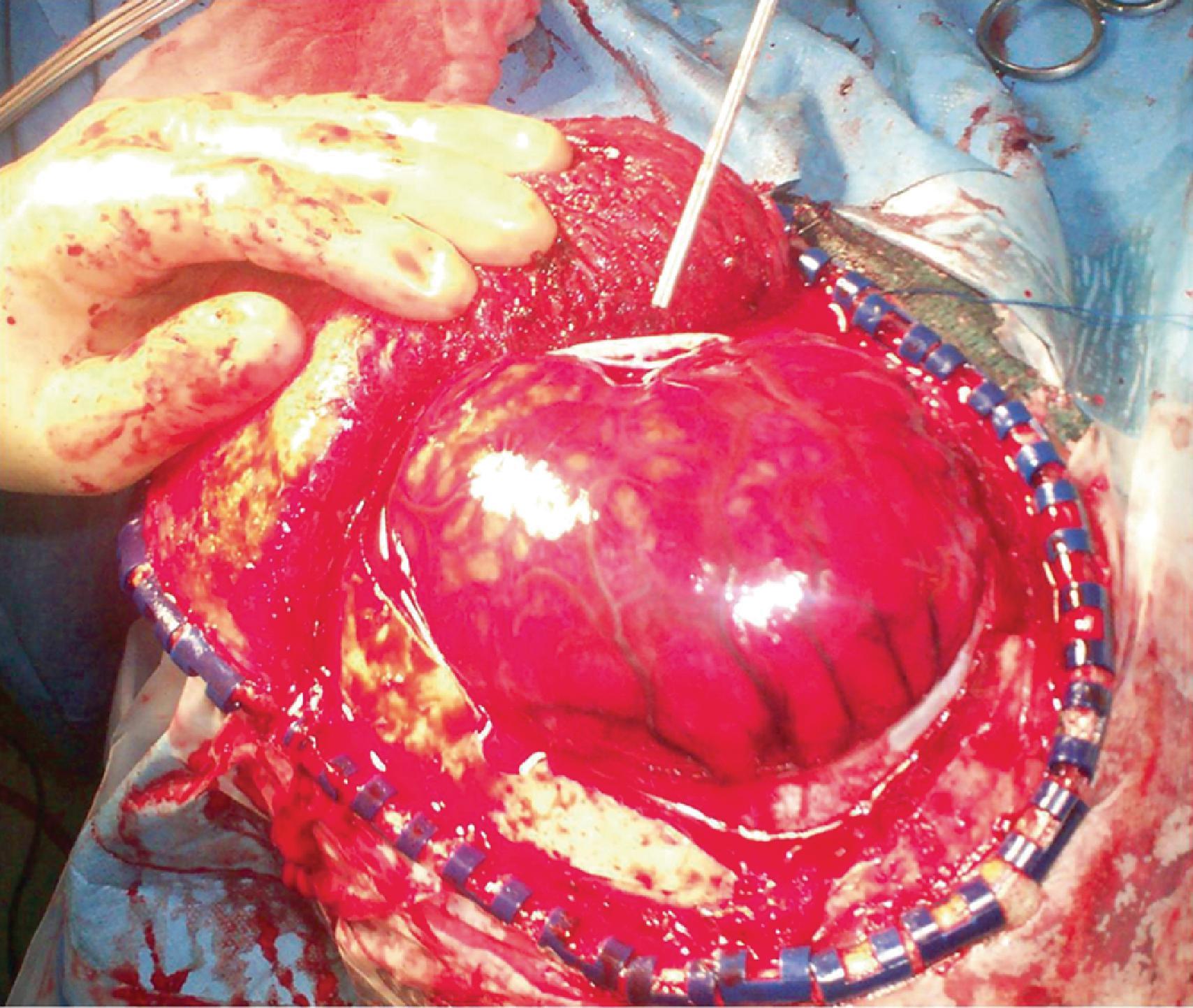 FIG. 4, Intraoperative image of a decompressive craniectomy with severely swollen and herniating brain parenchyma.