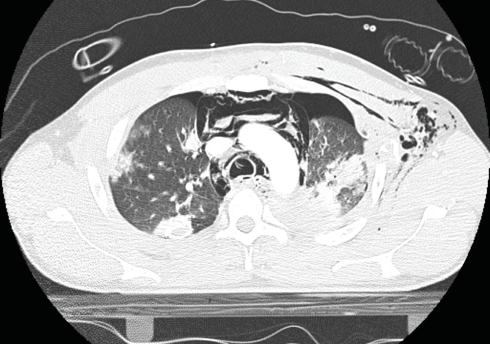 FIG. 1, CT scan of chest showing deformity of chest wall, rib fractures, bilateral pulmonary contusions, subcutaneous emphysema, and bilateral pneumothoraces.