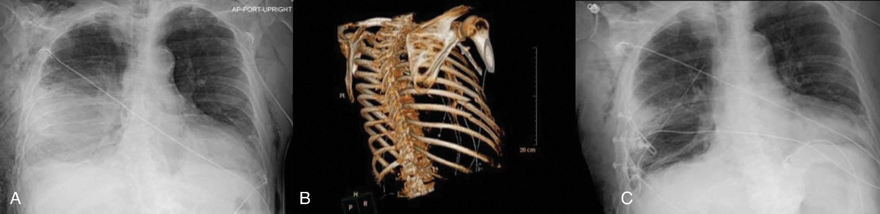 FIG. 3, (A) Preoperative chest x-ray demonstrating multiple right-side rib fractures and a large hemothorax. (B) Preoperative chest CT scan with 3D reconstruction showing several displaced right rib fractures. (C) Postoperative chest x-ray showing appearance of the rib plates placed via thoracoscopy. Residual pulmonary contusion is observed.