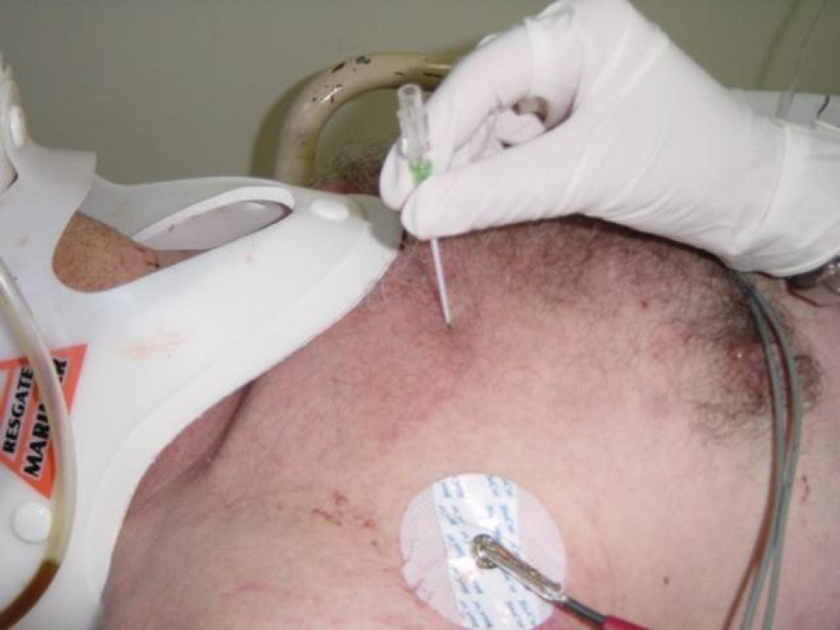 FIG. 4, Needle decompression for tension pneumothorax.